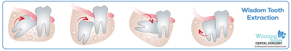Wisdom Tooth Extraction Removal
