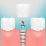 Dental Implants - Winning smiles dental surgery-blacktown