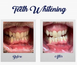 Teeth Whitening - Winning Smile Dental Surgery - Blacktown Teeth Whitening - Winning Smile Dental Surgery - Blacktown