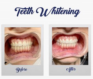 Teeth Whitening - Winning Smile Dental Surgery - Denham Court Teeth Whitening - Winning Smile Dental Surgery - Denham Court
