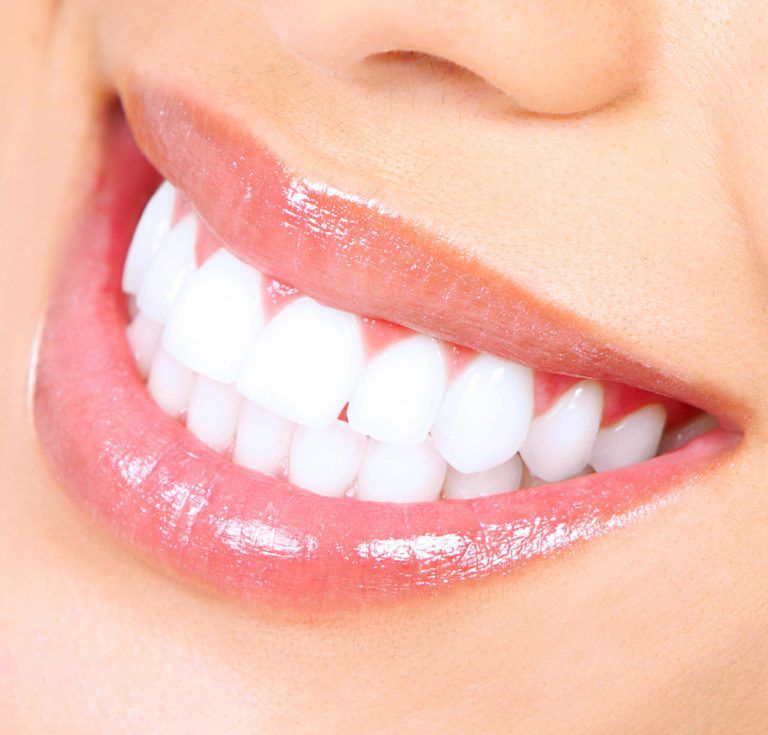 Winning Smiles Teeth Whitening for Life