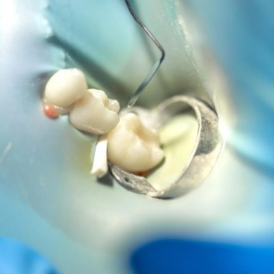 Wisdom Teeth: Myths, Facts, and When to Consider Removal