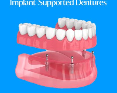 Implant-Supported Dentures: A Modern Solution for Confident Smiles