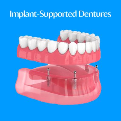 Implant-Supported Dentures: Restore Your Smile the Modern Way