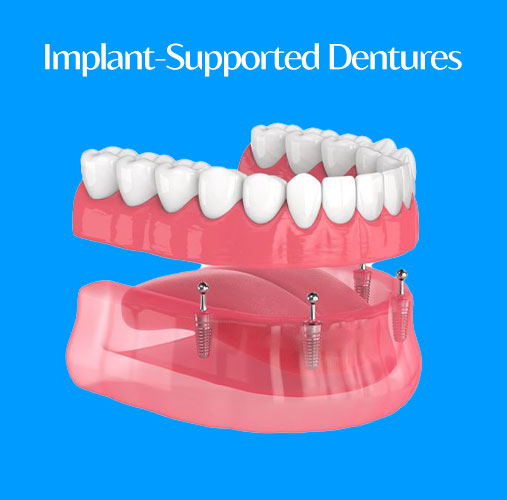 Implant-Supported Dentures: A Modern Solution for Confident Smiles