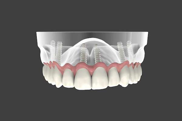 Implant-Supported Dentures: A Modern Solution for Confident Smiles